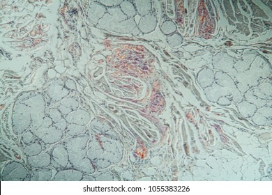 Amyloid Deposits In The Tongue Under The Microscope