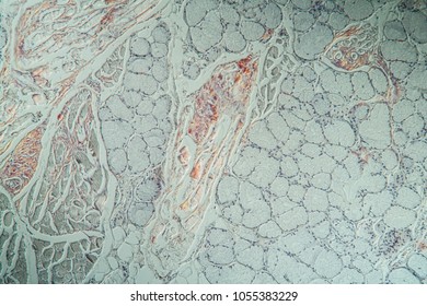 Amyloid Deposits In The Tongue Under The Microscope