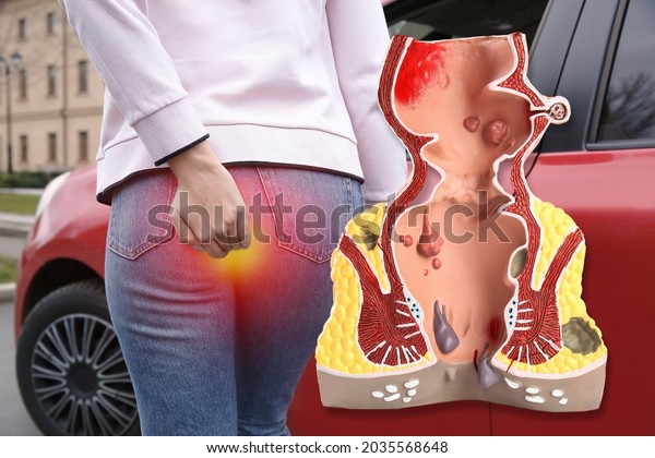 Anatomical model of rectum with\
hemorrhoids. Woman suffering from pain outdoors,\
closeup