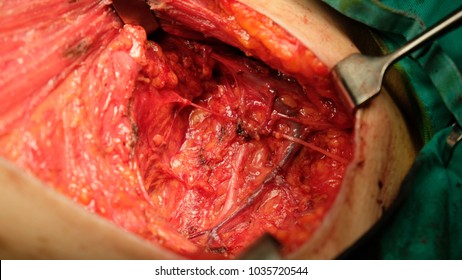 Anatomy of Axilla after axillary dissection in Mastectomy  and Axillary Clearance Surgery