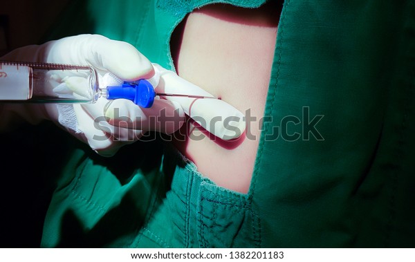 患者の背中に硬膜外針を持つ麻酔医 脊髄麻酔注射 帝王切開手術用のsoat注射の準備の硬膜外麻酔注射 の写真素材 今すぐ編集 1311