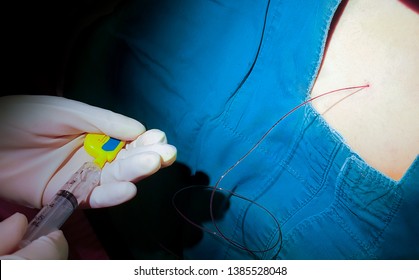 229 Catheter Spine Images, Stock Photos & Vectors | Shutterstock