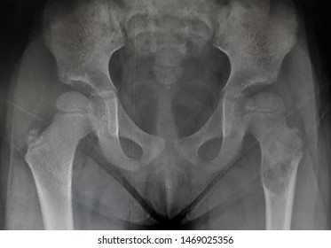 Aneurysmal Bone Cyst Of A Proximal Femur Is Shown Cavity Or Radiolucent In X-ray Film.