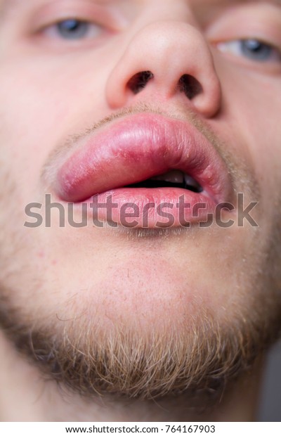 Angioedema Allergic Reaction On Upper Lip Stock Photo Edit Now 764167903