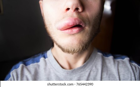 Angioedema In A Young Man On The Upper Lip.