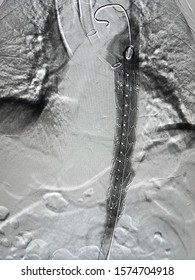 Angiogram After Expandable Aortic Stent Graft At Thoracic Aorta During TEVAR Procedure.