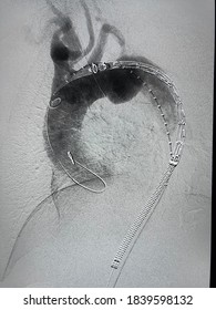 Angiogram Of Aorta Shown Aortic Arch Aneurysm During Thoracic Endovascular Aortic Repair (TEVAR). Thoracic Endovascular Stent Grafts With Delivery System Before Deployment.