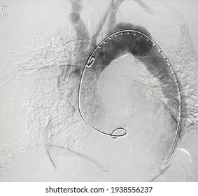 Angiogram of aorta shown aortic dissection type B at descending aorta during Thoracic endovascular aortic repair (TEVAR).