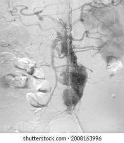 Angiogram of aorta shown Infra-renal abdominal aortic aneurysm (AAA) during endovascular aortic aneurysm repair (EVAR) procedure.