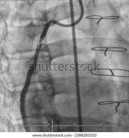 Angiogram was performed severe stenosis at saphenous vein graft (SVG) to posterior lateral artery (PL) in patient post coronary artery bypass graft (CABG).