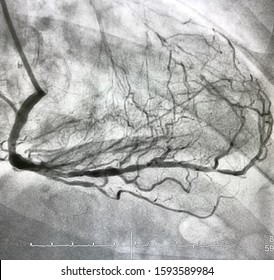 Angiogram Of Right Coronary Artery With Collateral Branches To LAD.