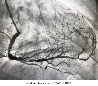 Angiogram Of Right Coronary Artery With Collateral Branches To LAD.