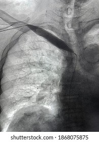 Angiogram Shown Balloon Catheter Inflated At Arteriovenous (AV) Graft Of Hemodialysis In End Stage Renal Disease (ESRD) Patient.