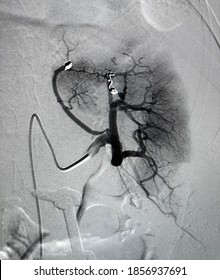 Angiogram Shown Renal Artery After Coil Embolization Procedure.