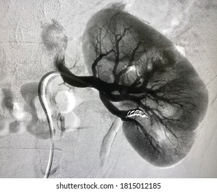 Angiogram shown renal artery with coil embolization.