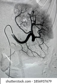 Angiogram Shown Renal Artery Rupture 
With Bleeding Around Lesion.