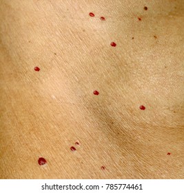 Angioma On Skin Red Moles On Stock Photo 785774461 | Shutterstock