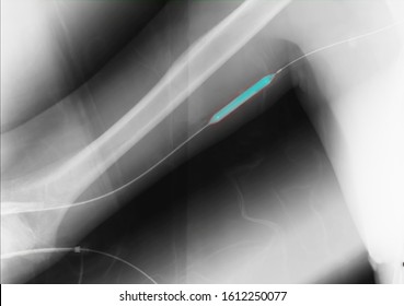 Angioplasty, Balloon Angioplasty And Percutaneous Transluminal Angioplasty (PTA) On Right Arm.