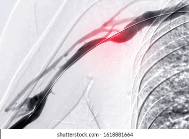 Angioplasty, balloon angioplasty and percutaneous transluminal angioplasty (PTA) on right arm. medical background.