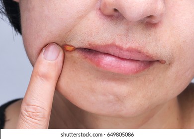 Angular Cheilitis Is A Type Of Common Inflammation Of The Lips