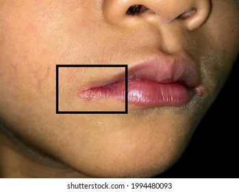 Angular stomatitis or angular cheilitis or perleche in asian little boy. inflammatory condition of angles of mouth. Caused by iron, zinc or B12 deficiency, or repetitive trauma. Isolated on black