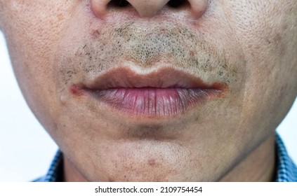 Angular stomatitis or angular cheilitis or perleche in asian alcoholic man. Common inflammatory condition of angles of mouth. Cracked lips.