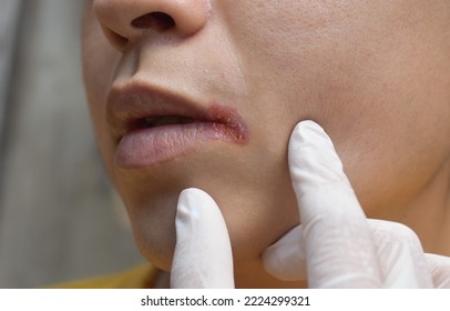 Angular stomatitis or angular cheilitis or perleche in asian young man. Common inflammatory condition caused by iron, zinc or B12 deficiency, or repetitive trauma.