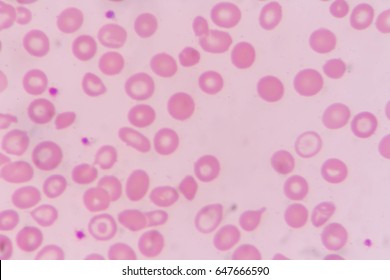 Anisocytosis On Blood Smear Stock Photo 648122050 | Shutterstock