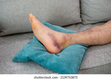 Ankle Injury With Dislocation And Sprains. Fracture Or Leg Sprain Injury Of Young Sports Man. 