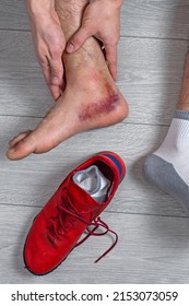 Ankle Injury With Dislocation And Sprains. Fracture Or Leg Sprain Injury Of Young Sports Man. 