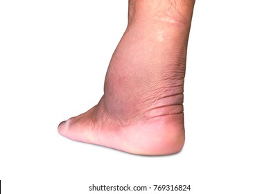 Ankle Sprain And Swelling From Playing Sport