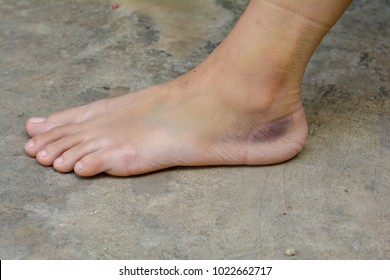 Ankle sprained and Bruise.
