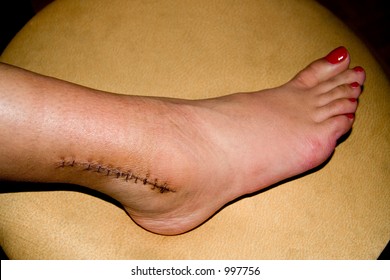 Ankle Surgery Scar With Staples.