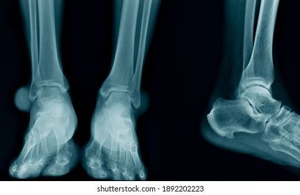ankle x-ray image in blue tone on black background