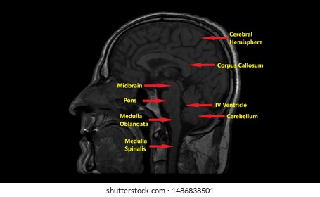 Annotated MRI Anatomy Of Brain (Saggital Plane)