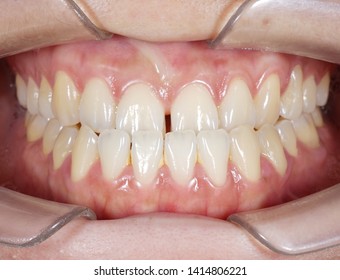 Crossbite Hd Stock Images Shutterstock