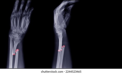 
Anterior and lateral forearm x-ray images show distal humerus fractures. - Shutterstock ID 2244523465