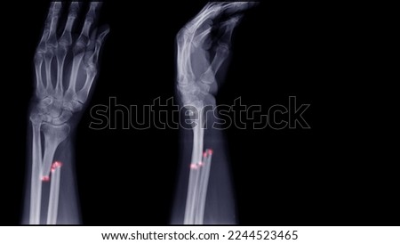 
Anterior and lateral forearm x-ray images show distal humerus fractures.