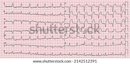anterior miyocardial infarction findings on electrocardiogram