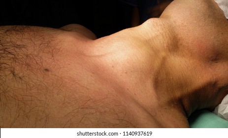 Anterior Neck Swelling, Goitre being prepared for Surgery. The neck is supported in extended position for proper visualisation. The operation called as Thyroidectomy.