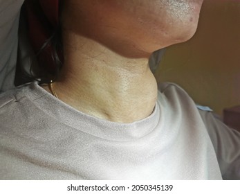 Anterior Neck Swelling Known As Goitre Vecause Of Enlargement Of Thyroid Gland.