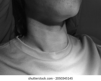 Anterior Neck Swelling Known As Goitre Vecause Of Enlargement Of Thyroid Gland.