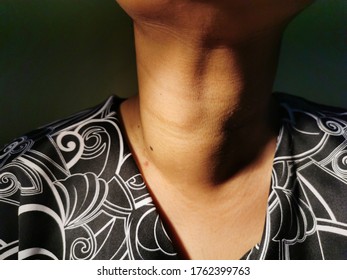 Anterior neck swelling also known medically as Goitre, enlargement of thyroid gland.