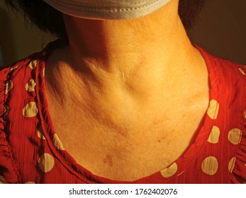Anterior neck swelling also known medically as Goitre, enlargement of thyroid gland.