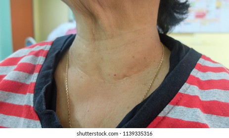 Anterior neck swelling. The left thyroid lobe enlarged and require hemithyroidectony.