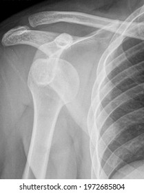 Anterior Shoulder Dislocation Xray Bone