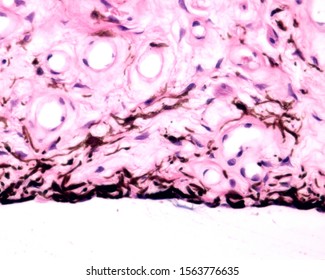 Anterior surface of the iris bordered by stromal fibroblasts and melanocytes (non-epithelial). Above, the stroma shows fibroblasts, star shaped melanocytes and blood vessels.