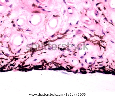 Anterior surface of the iris bordered by stromal fibroblasts and melanocytes (non-epithelial). Above, the stroma shows fibroblasts, star shaped melanocytes and blood vessels.