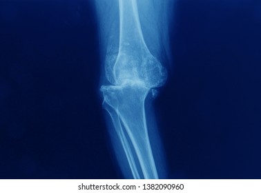 An Anterolateral X-ray Or Radiograph Showing Severe Stage Of Knee Osteoarthritis. The Knee Show Varus Angulation Or Bow Leg. Subchondral Bone Sclerosis. Osteophyte