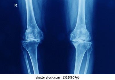 An Anterolateral X-ray Or Radiograph Showing Severe Stage Of Knee Osteoarthritis. The Knee Show Lateral Or Varus Angulation And Bow Leg.